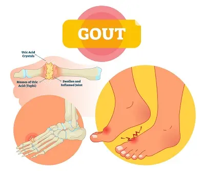 Gout Rheumatoid Arthritis